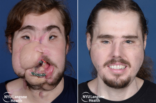 Cameron Underwood-face-transplant-01.jpg
