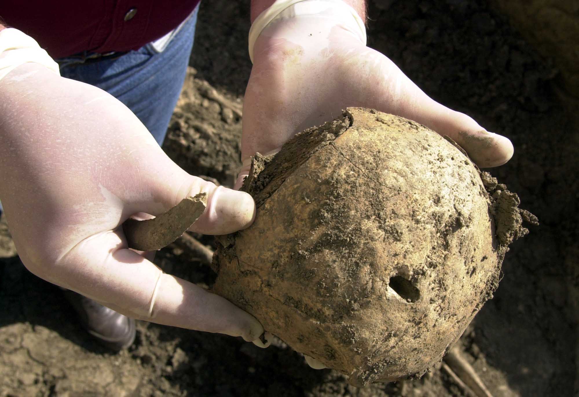 Τρύπα σε κρανίο