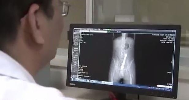 kina.jpg Στα επείγοντα με μία ράβδο στο σώμα του