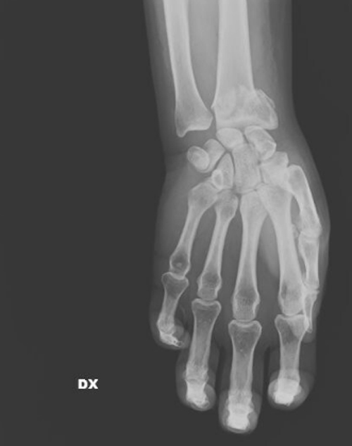 Σπασμένος καρπός