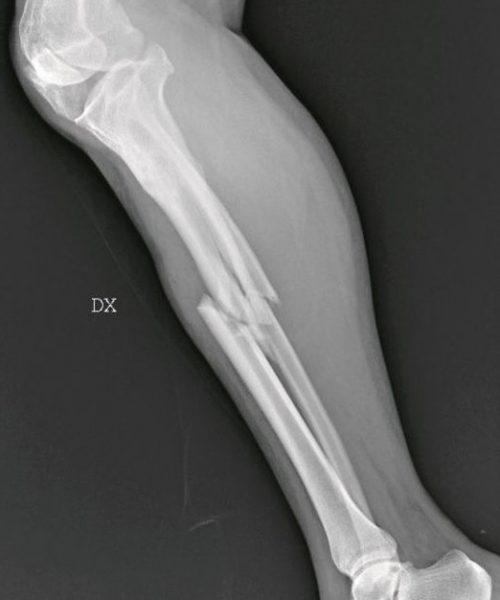 Σπασμένη κνήμη