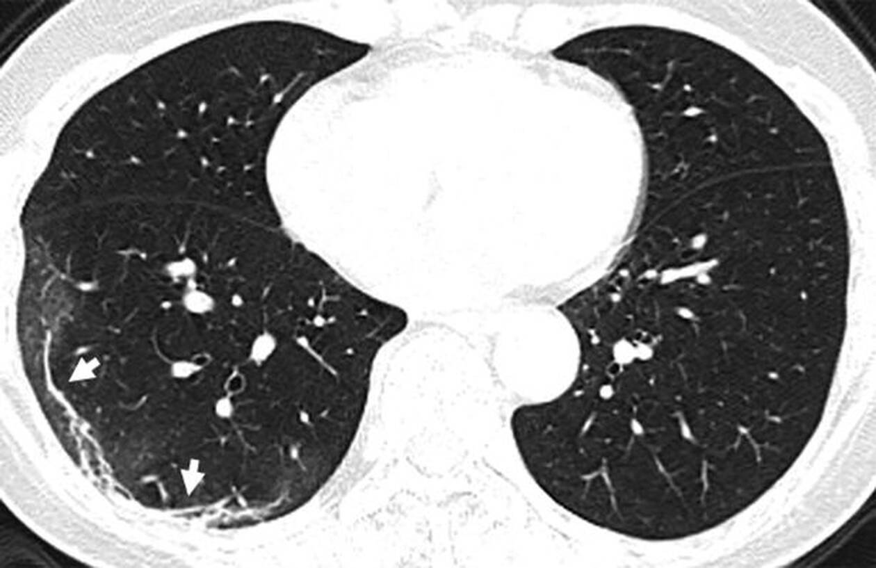 koronaios.jpg Οι πνεύμονες μιας 59χρονης με υψηλό πυρετό.
