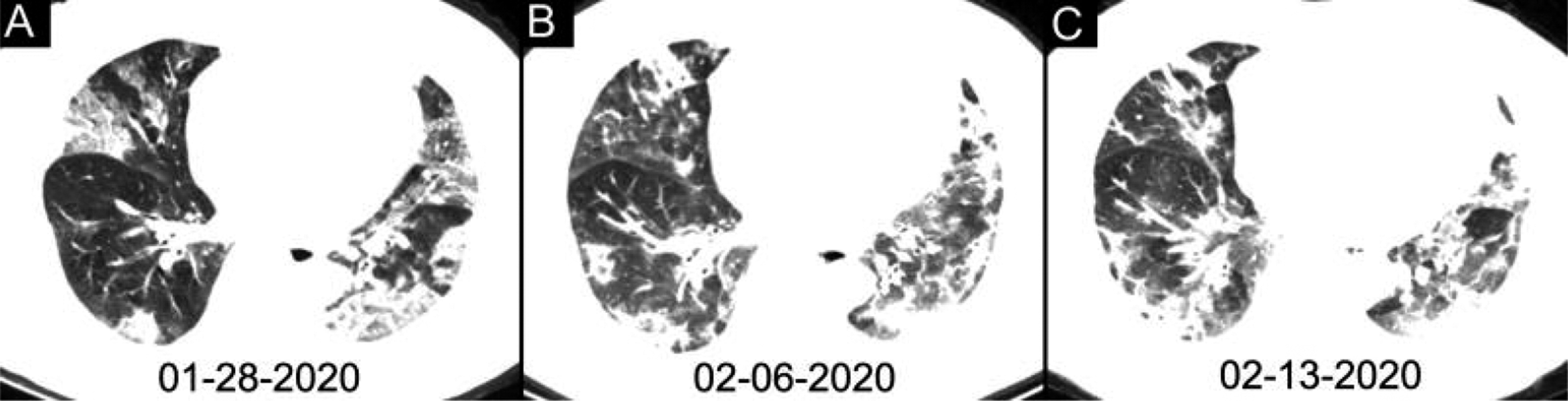 radiol.2020200642.fig6_.jpeg ακτινογραφία στους πνεύμονες