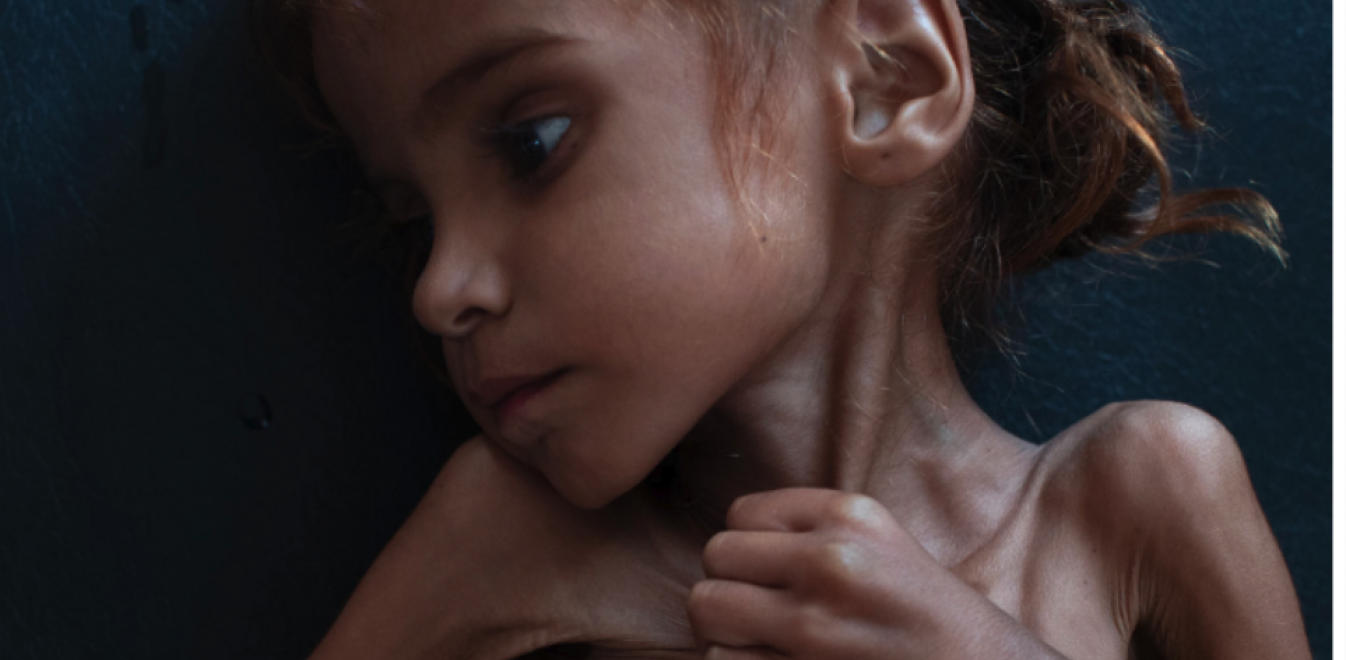 Πέθανε από την πείνα το κορίτσι σύμβολο του λιμού στην Υεμένη