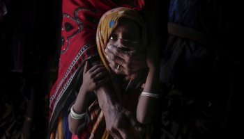 Υποσιτισμένο παιδί στην Υεμένη